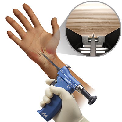 Obr.: 2: SmartRelease® instrumentárium k provedení ECTR od firmy Microaire
