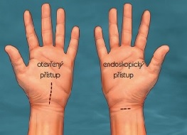 Obr. č. 1. Srovnání velikosti a lokalizace operačních přístupů/řezů